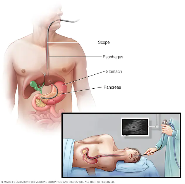 Pancreatic Ultrasound